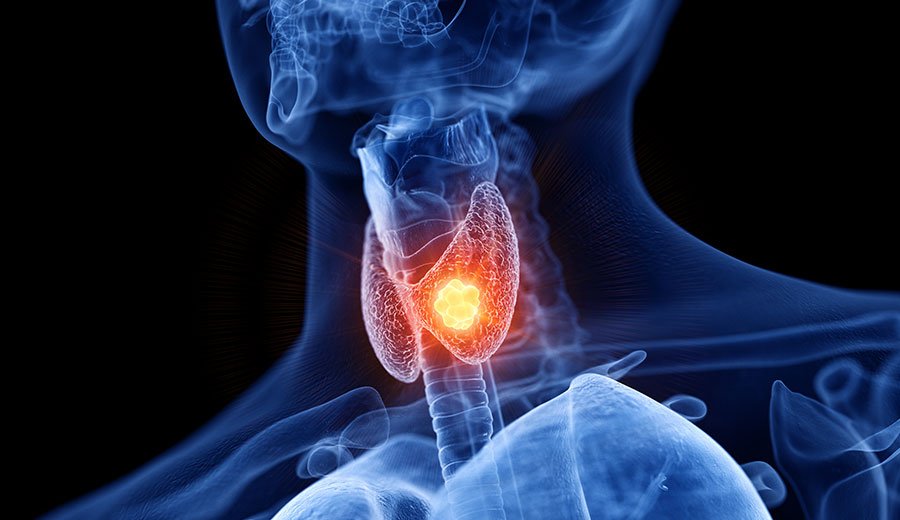 Câncer de tireoide: O que o paciente precisa saber sobre
