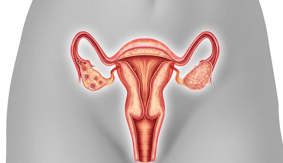 Ooforectomia x Ooforoplastia - Cirurgia no ovário 